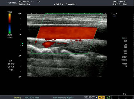動脈硬化のない頸動脈の血流エコー