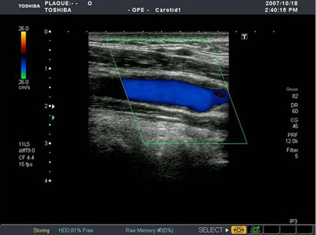 動脈硬化の進んだ頸動脈のエコー
