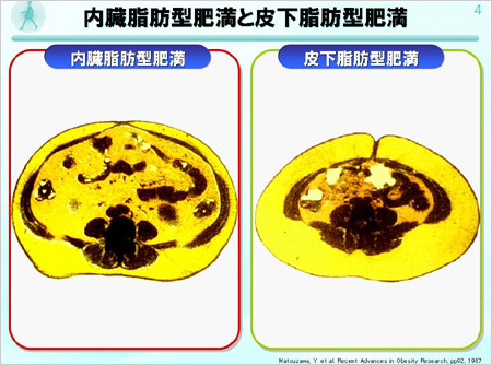 内臓脂肪型肥満と皮下脂肪型肥満