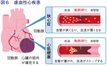 図6：虚血性心疾患