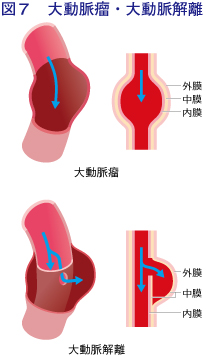 図7：大動脈瘤・大動脈解離